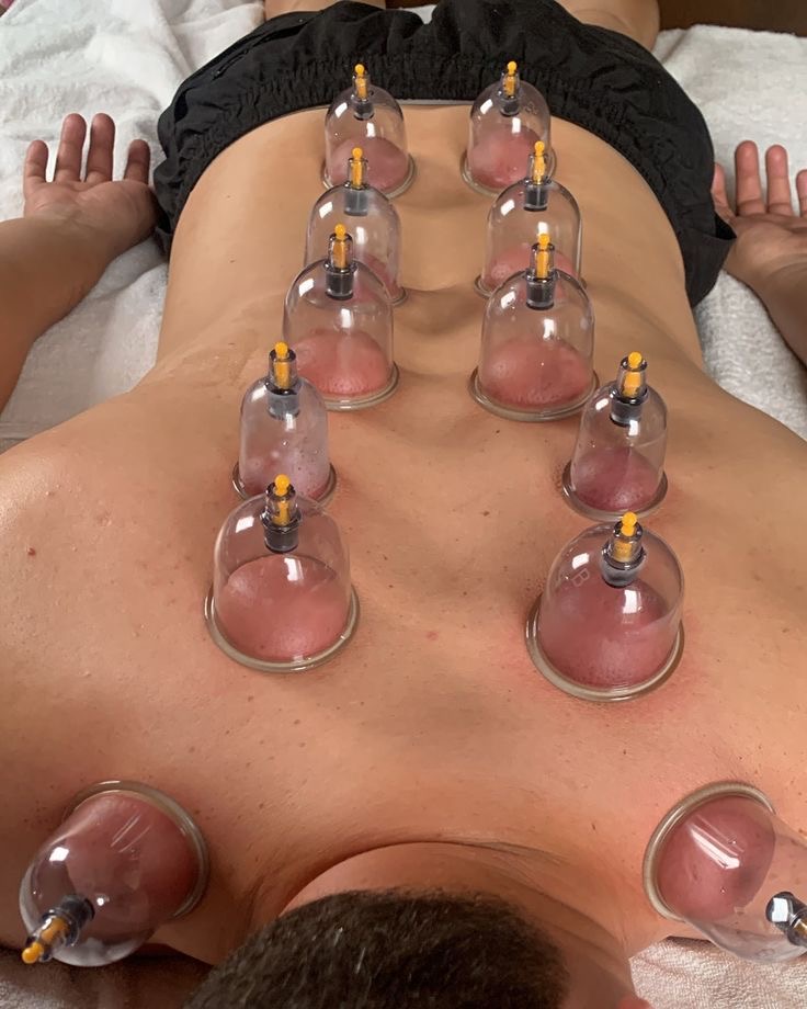 Vacuum Cupping Set